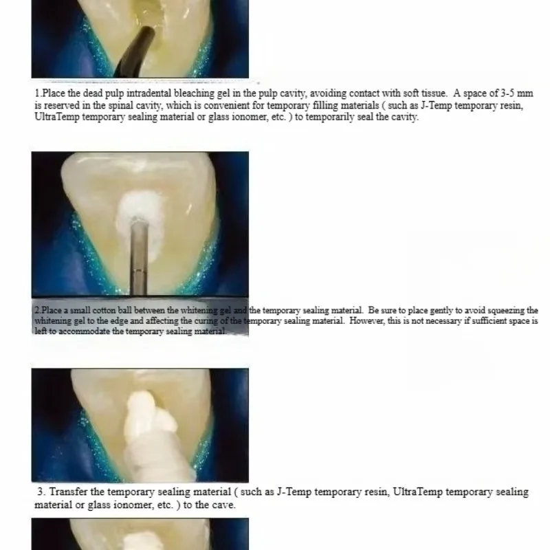 Dental Oral Restoration Materi - Teeth Whitening Effects ulasan dan harga