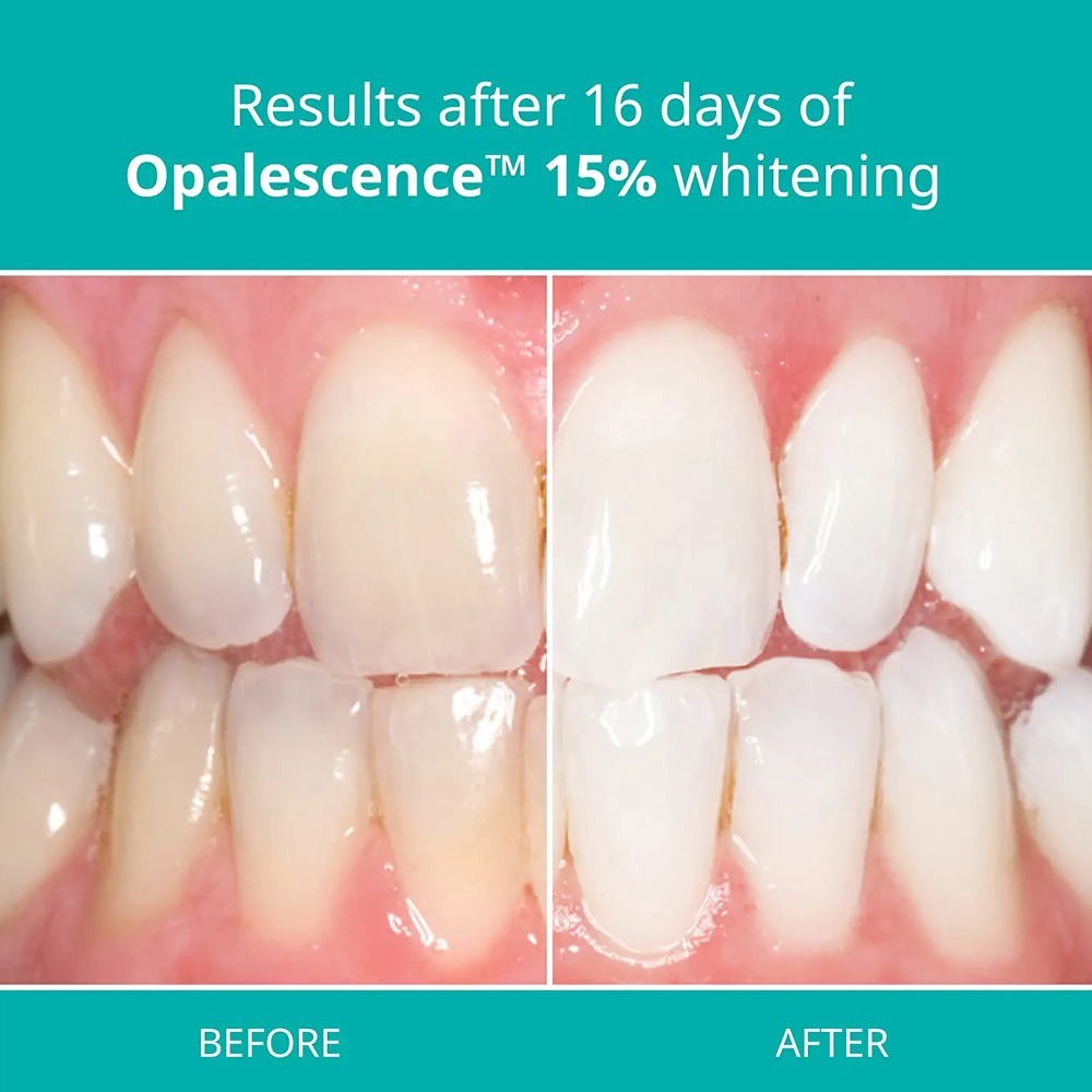 Opalescence Professional White - Teeth Whitening Gel Refills ulasan dan harga