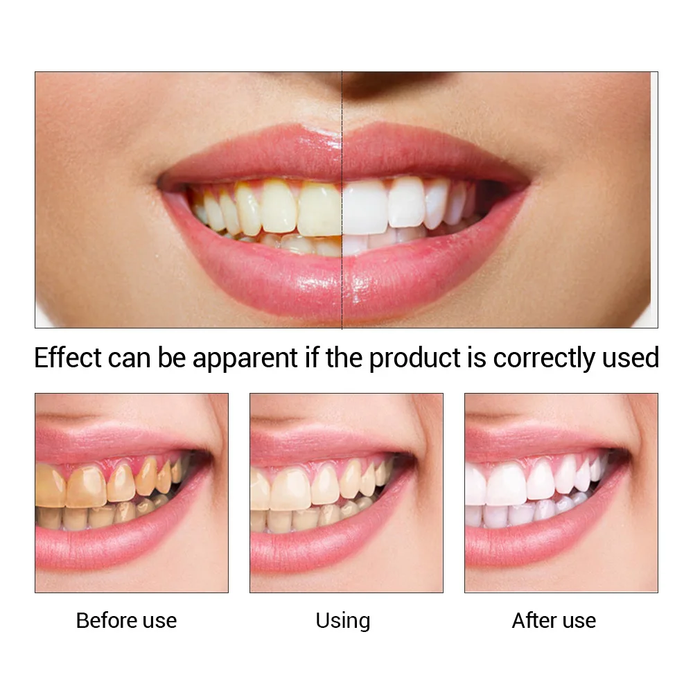 FTEENPLY Teeth Whitening Essen - Teeth Whitening Zimba ulasan dan harga
