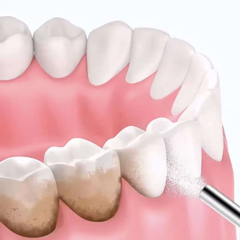 130g Dental Sandblasting Powde - Teeth Whitening Zimba ulasan dan harga
