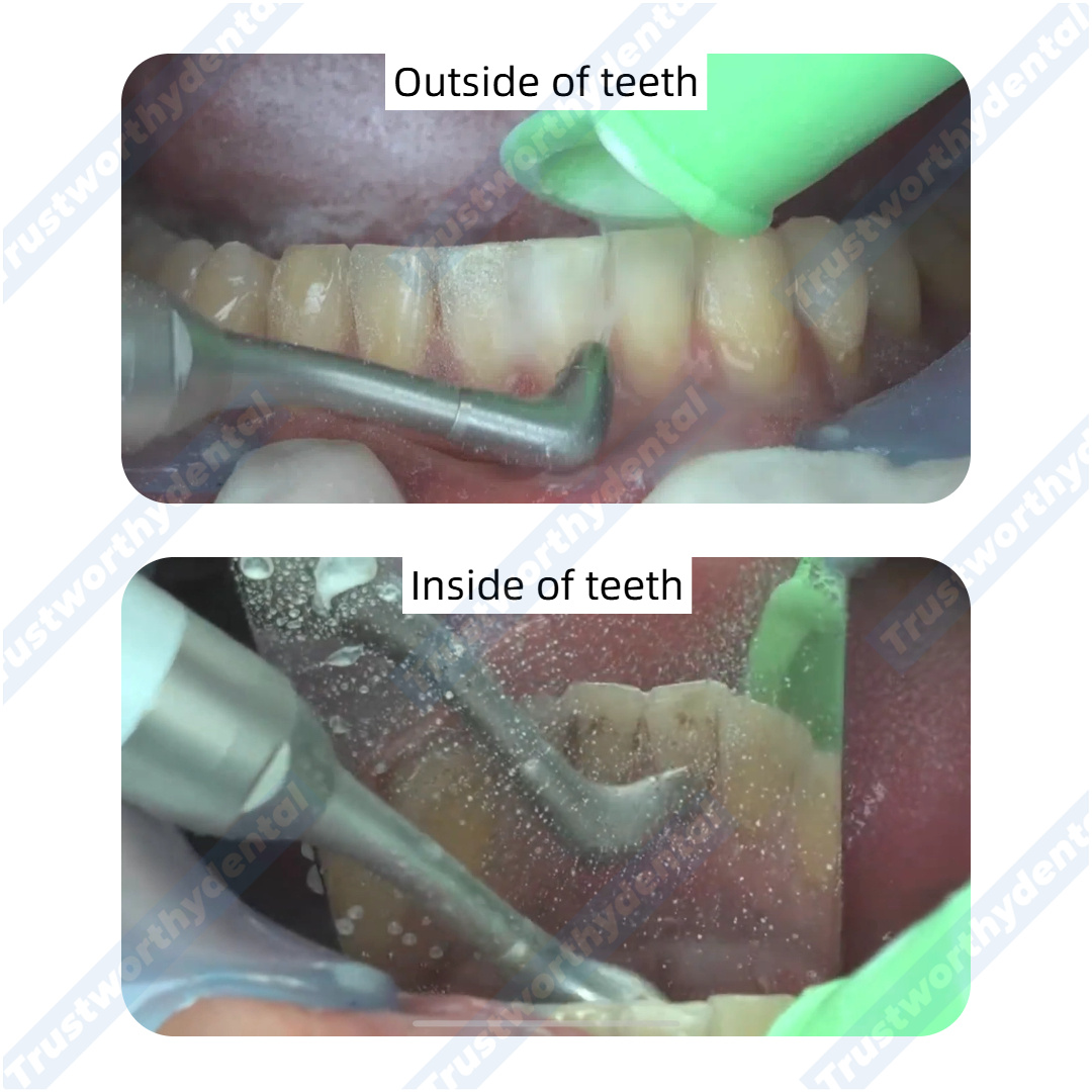 Dental Air Polisher Oral Autoc - Colgate Whitening Teeth ulasan dan harga