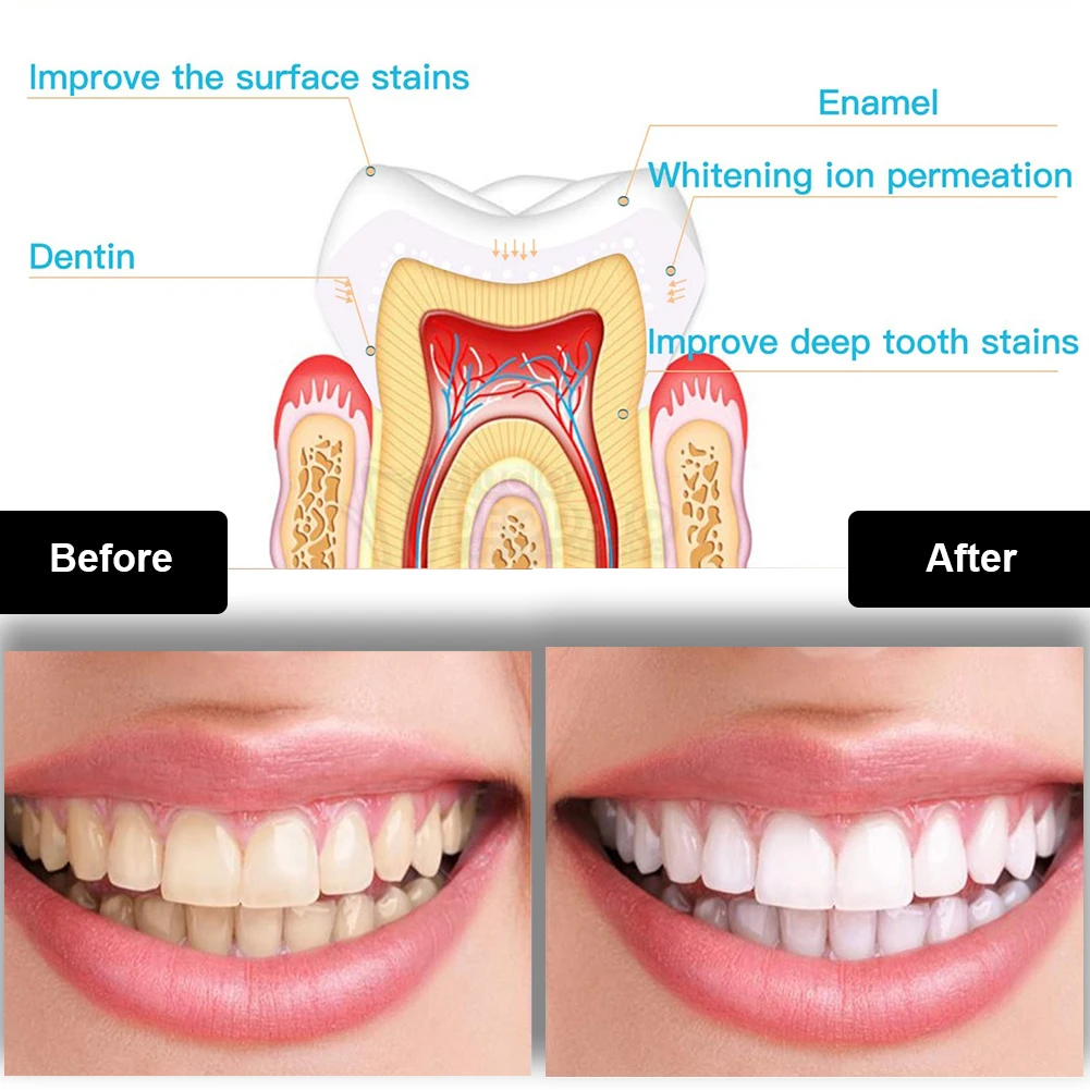 Dental Teeth Whitening Kit Min - Teeth Whitening Pens ulasan dan harga