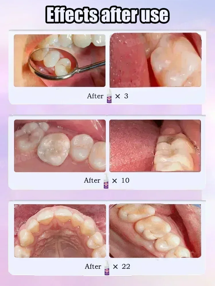 Teeth Cleaning Toothpaste Remo - Teeth Whitening Uv ulasan dan harga